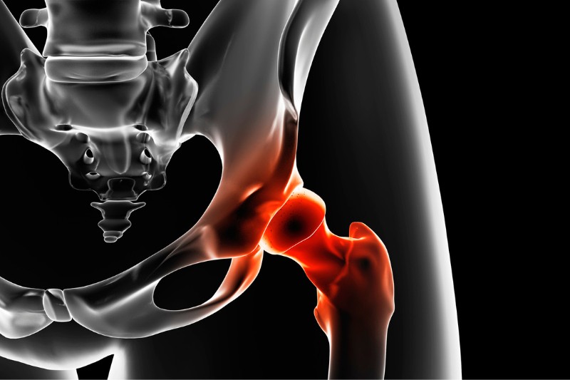 hip replacement surgery